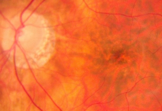 Eye scan showing vessels. 