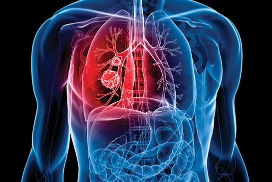 Graphic of lungs