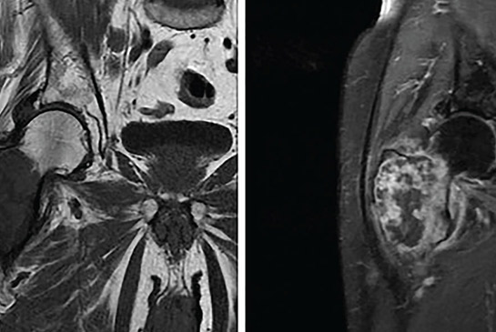 Preoperative MRI of right femur demonstrating large femoral ltyic mass