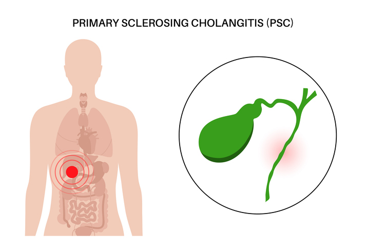 Scientific illustration of primary sclerosing cholangitis.