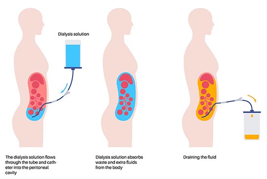 Diagram of three patient silohettes and stages of dialysis.