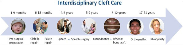 This graph illustrates a sample timeline of the interdisciplinary medical care that is used to treat patients with cleft lip and/or cleft palate differences from birth through early adulthood. The chart shows that from one to nine months, patients undergo pre-surgical preparation to evaluate their needs related to hearing loss, eating, dental and future speech issues. From six to eighteen months, surgical cleft lip and/or cleft palate repair may take place. From three to five years of age, patients’ speech is evaluated to see if there is additional surgical work is needed on the palate. Between five to twelve years of age, orthodontic work leading to alveolar bone graft may be completed. From the ages of seventeen through twenty-one, orthodontic work may be followed up with orthognathic surgery to align the jaws. Finally, the patient may have rhinoplasty surgery during this time to alter any remaining cleft appearance of the nose.