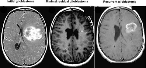Glioblastoma MRIs