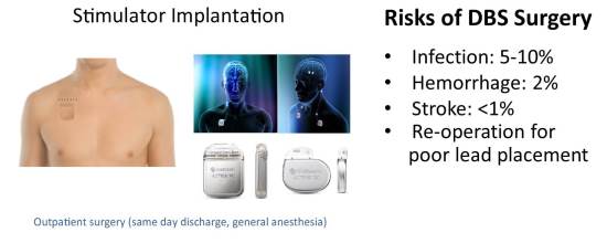 DBS implants and risks