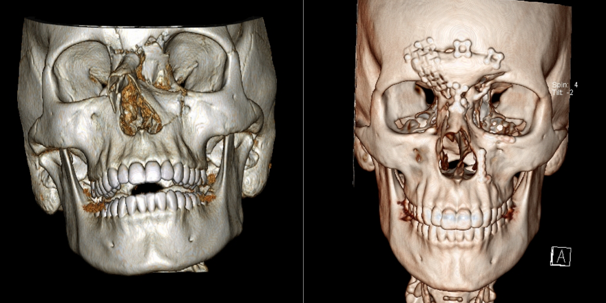 Dimensional CT scan of patient who suffered severe facial and skull fractures from a motor vehicle accident a) before and b) after surgical repair of the fractures.