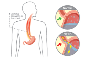 reflux graphic