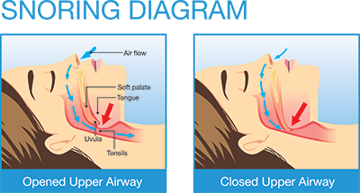Snoring / Obstructive Sleep Apnea