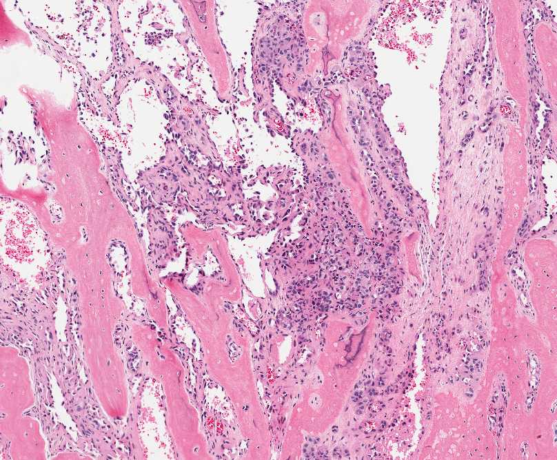 Figure 1: Tumor is composed of two distinct morphologic areas: 1) neoplastic cells forming nests and dilated vascular spaces, 2) metaplastic bone.