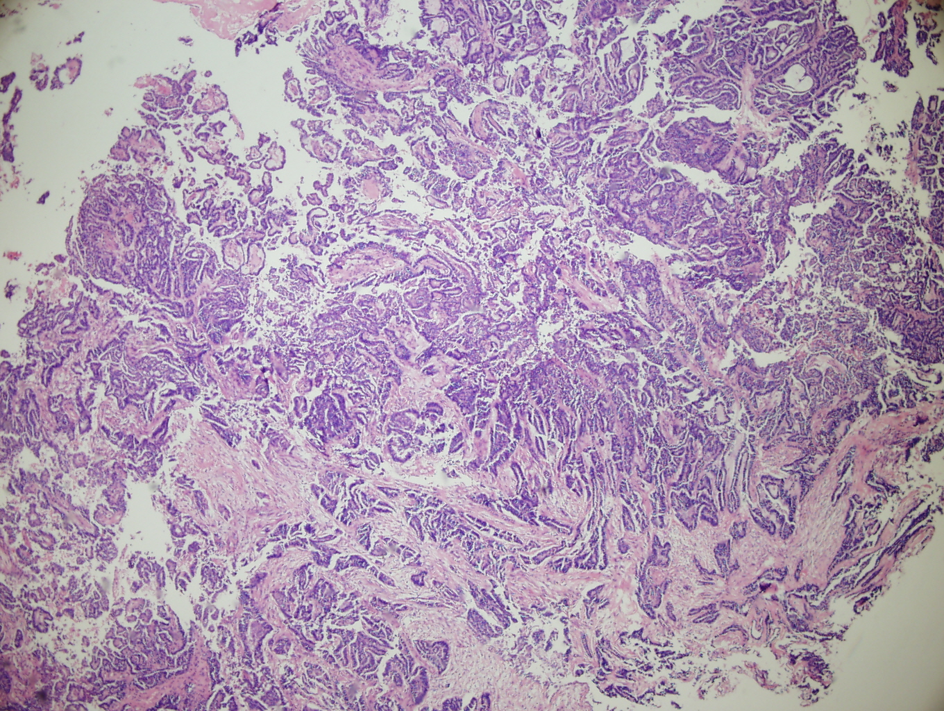 Figure 1: Low power (4X) view of section of tumor from the lower uterine segment. The tumor displays the ductal pattern of mesonephric adenocarcinoma with intraglandular villous papillae. Note the similarity of this appearance to the villoglandular variant of endometroid endometrial adenocarcinoma. secreting cells and containing papillary intracystic projections.