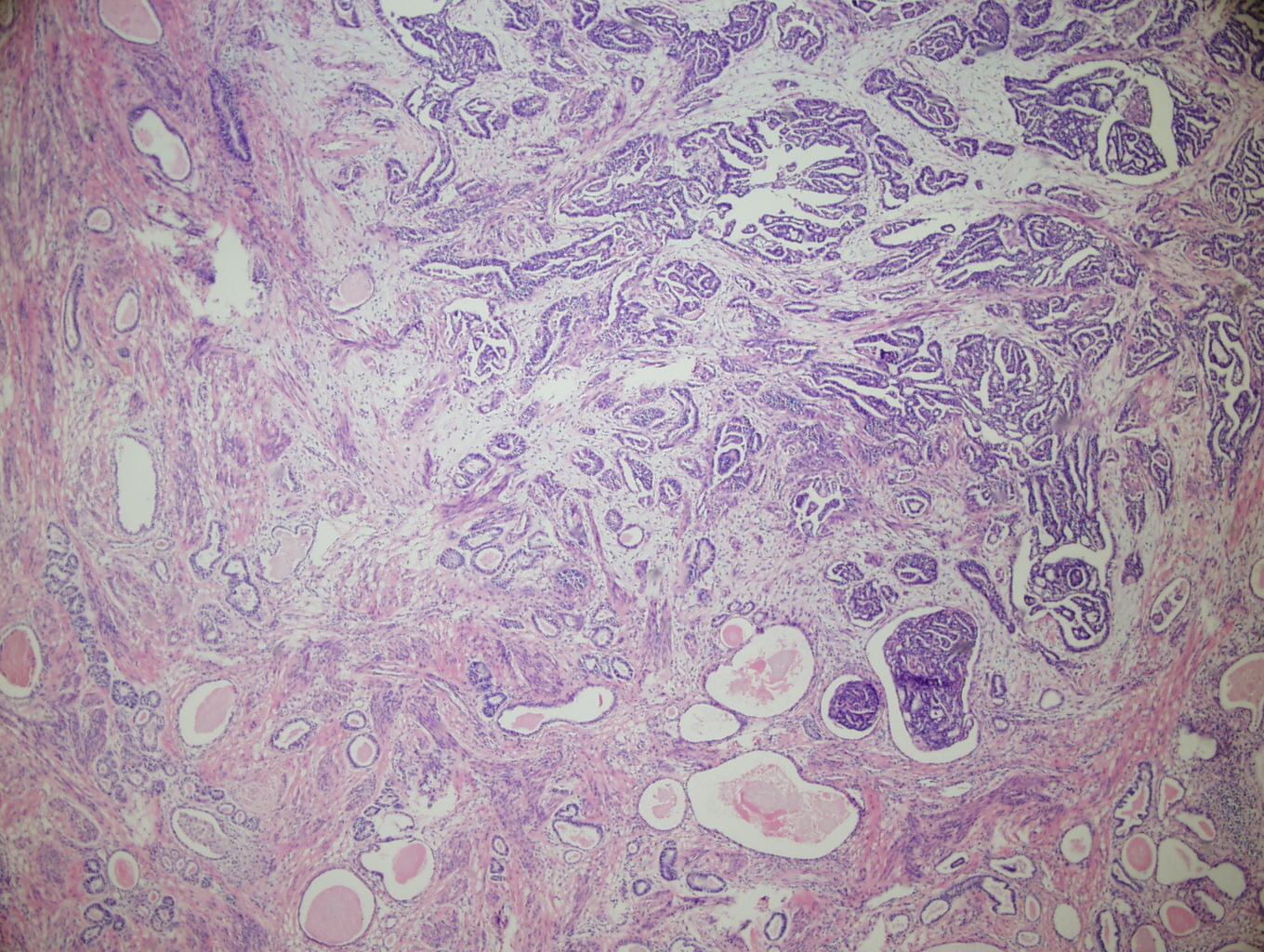 Figure 2: Low power (4X) view of tumor from lower uterine segment and cervix. A focus of irregular angular glands (some with papillary projections) is present adjacent to a varied proliferation of small and cystic dilated tubules (many of which have dense eosinophillic intraluminal secretions).