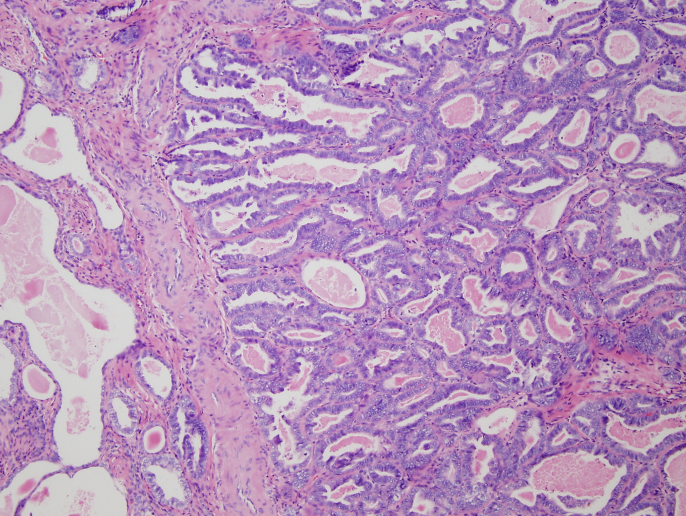 Figure 3: Mid-power (10X) view of tumor from cervix showing angulated glands adjacent to scattered cystically dilated and small tubules. These structures are lined by columnar to cuboidal to flattened cells with hyperchromatic nuclei. Dense, eosinophillic intraluminal secretions are a prominent feature.
