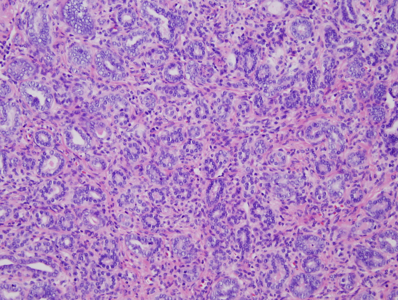 Figure 4: High power (20X) view of tumor from cervix showing tubular pattern with crowded small round tubules lined by single to multiple layers of cuboidal  to low columnar cells with enlarged hyperchromatic nuclei.