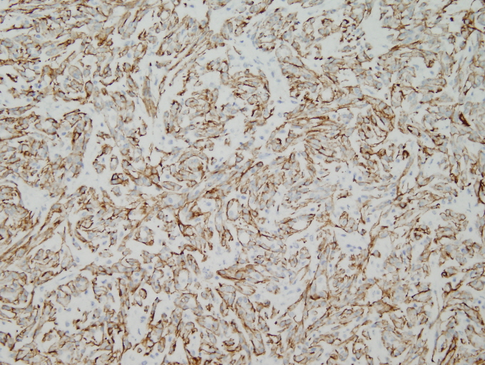 COTM June 2010 Immunohistochemical stains: Figure 1 of 3 (AE1/AE3 20x)