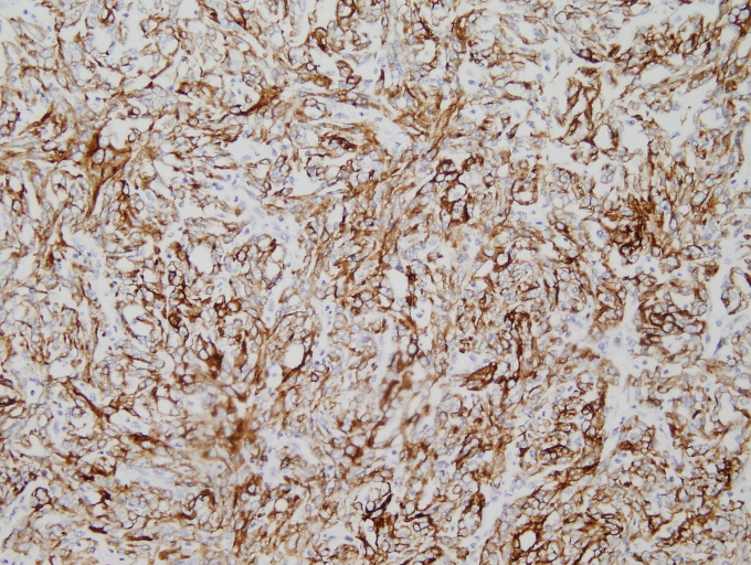 COTM June 2010 Immunohistochemical stains: Figure 2 of 3 (CAM 5.2 20x)