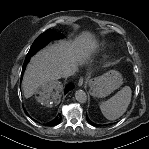 Abdominal MRI (Click to enlarge)