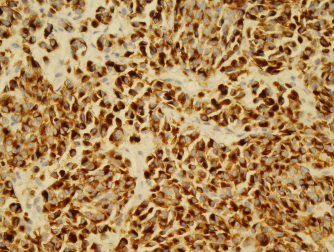 Microscopic image 6 - Liver core biopsy, HMB45 (Click to enlarge)