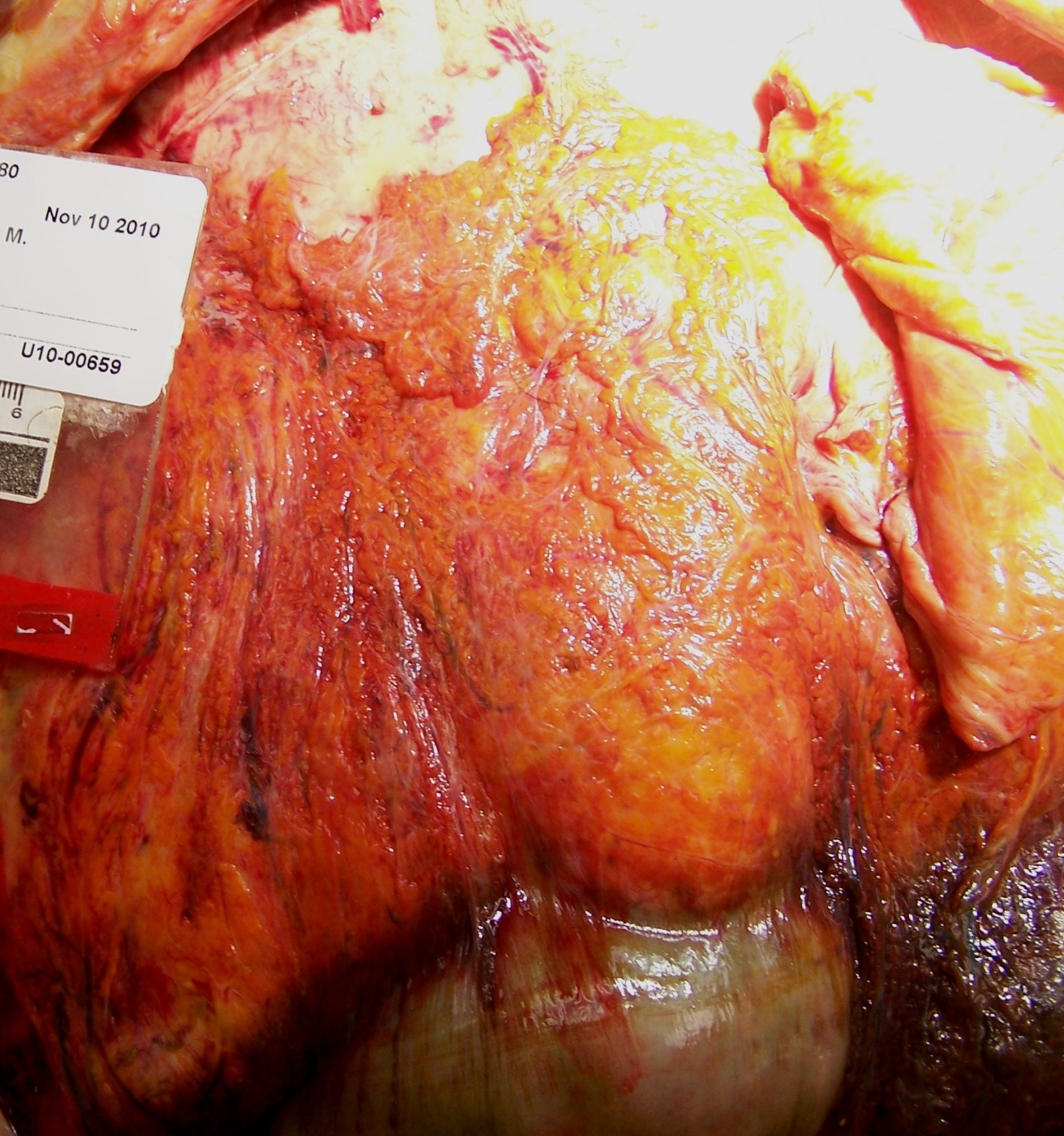 Gross image - Autopsy image, liver in situ (Click to enlarge)