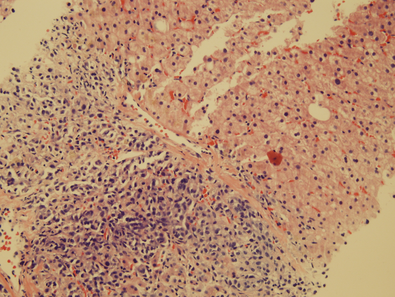 Microscopic image 3 - Liver core biopsy, H&E (Click to enlarge)