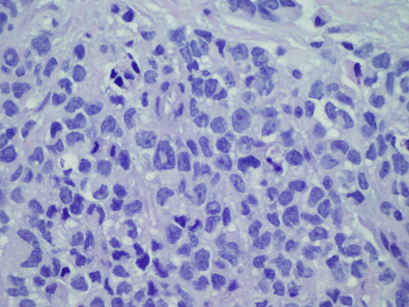Microscopic image 2 - Biopsy from breast mass, 60x (Click to enlarge)