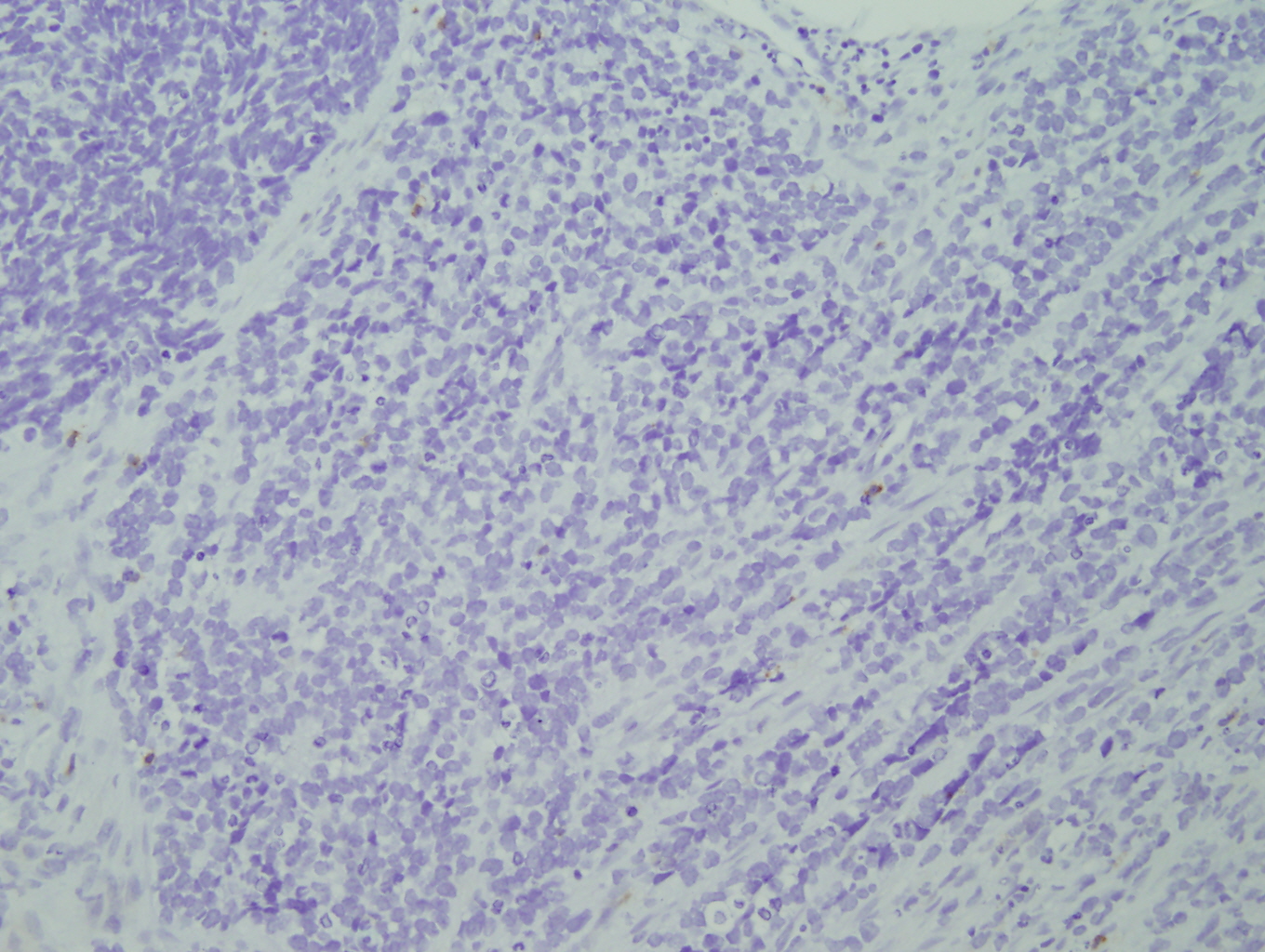 Microscopic image 5 - Biopsy from bone marrow, CD45 (Click to enlarge)