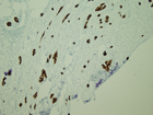 Microscopic image 12: Appendix, CEA (Click to enlarge)