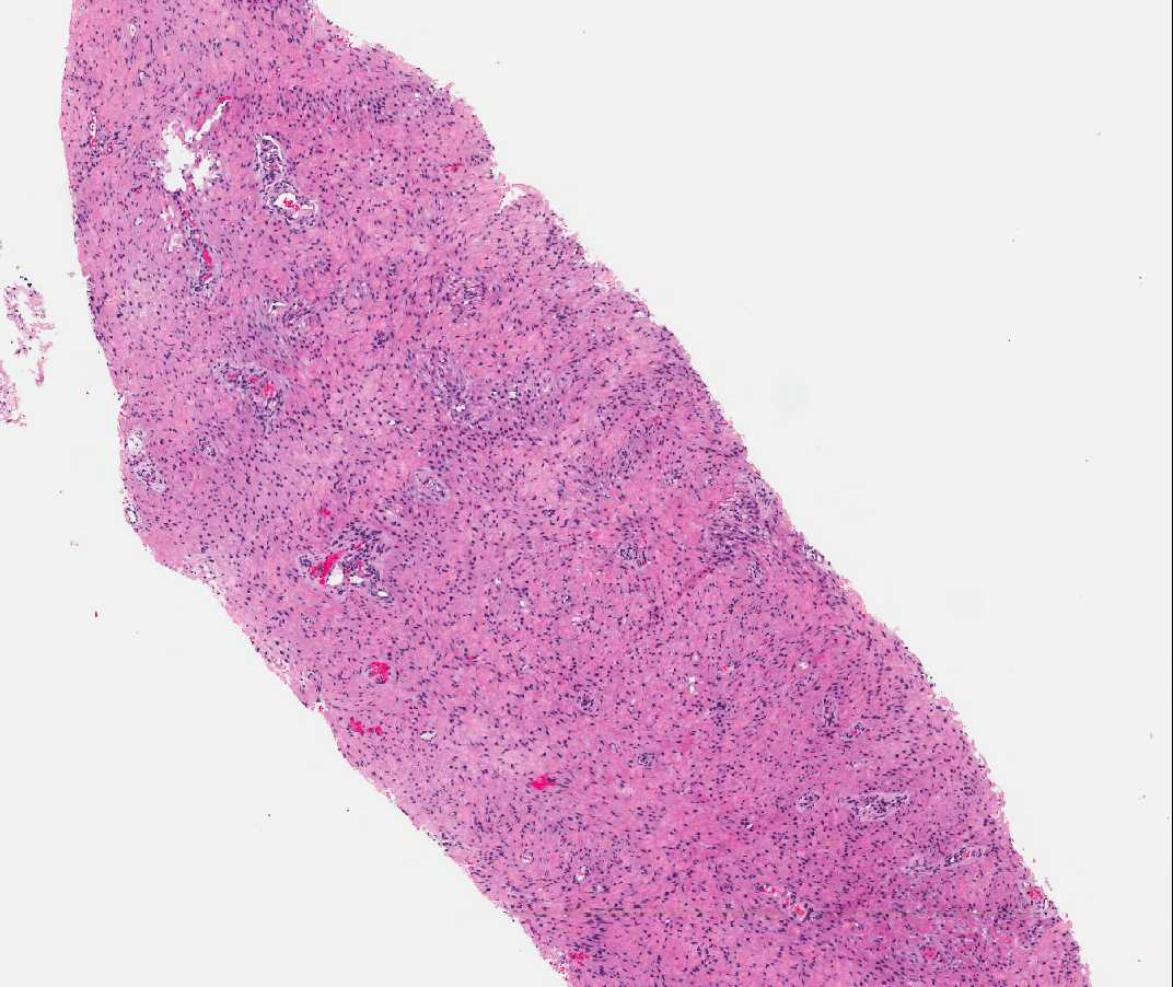 Case of the Month, Aug. 2012: Microscopic images - Figure 1