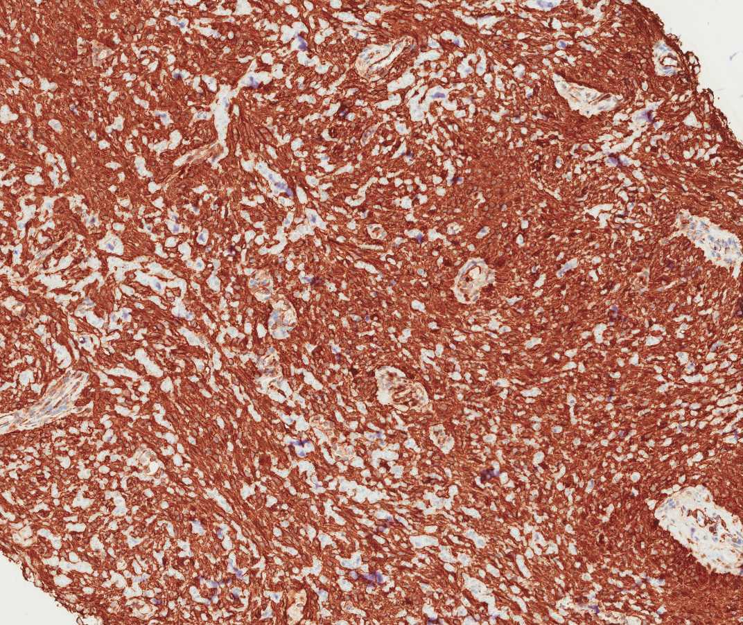 Case of the Month, Aug. 2012: Immunohistochemistry images - Figure 5