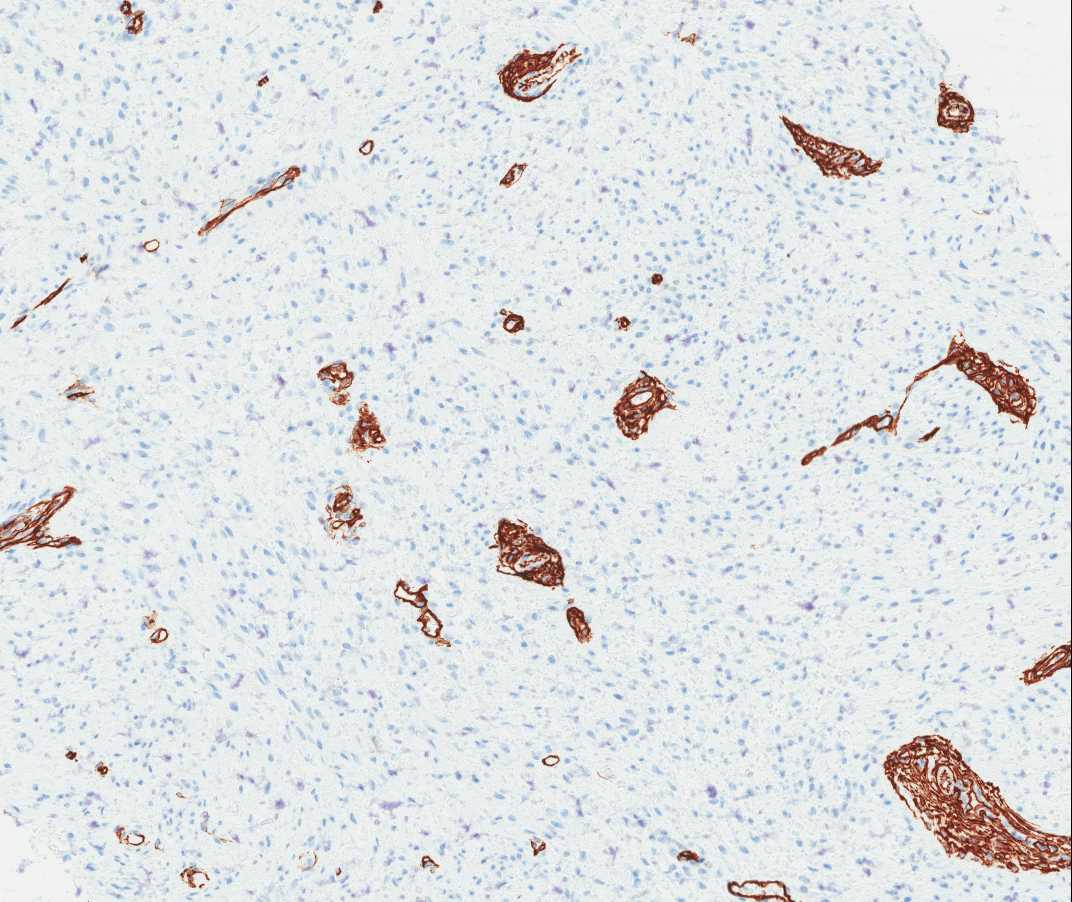Case of the Month, Aug. 2012: Immunohistochemistry images - Figure 6