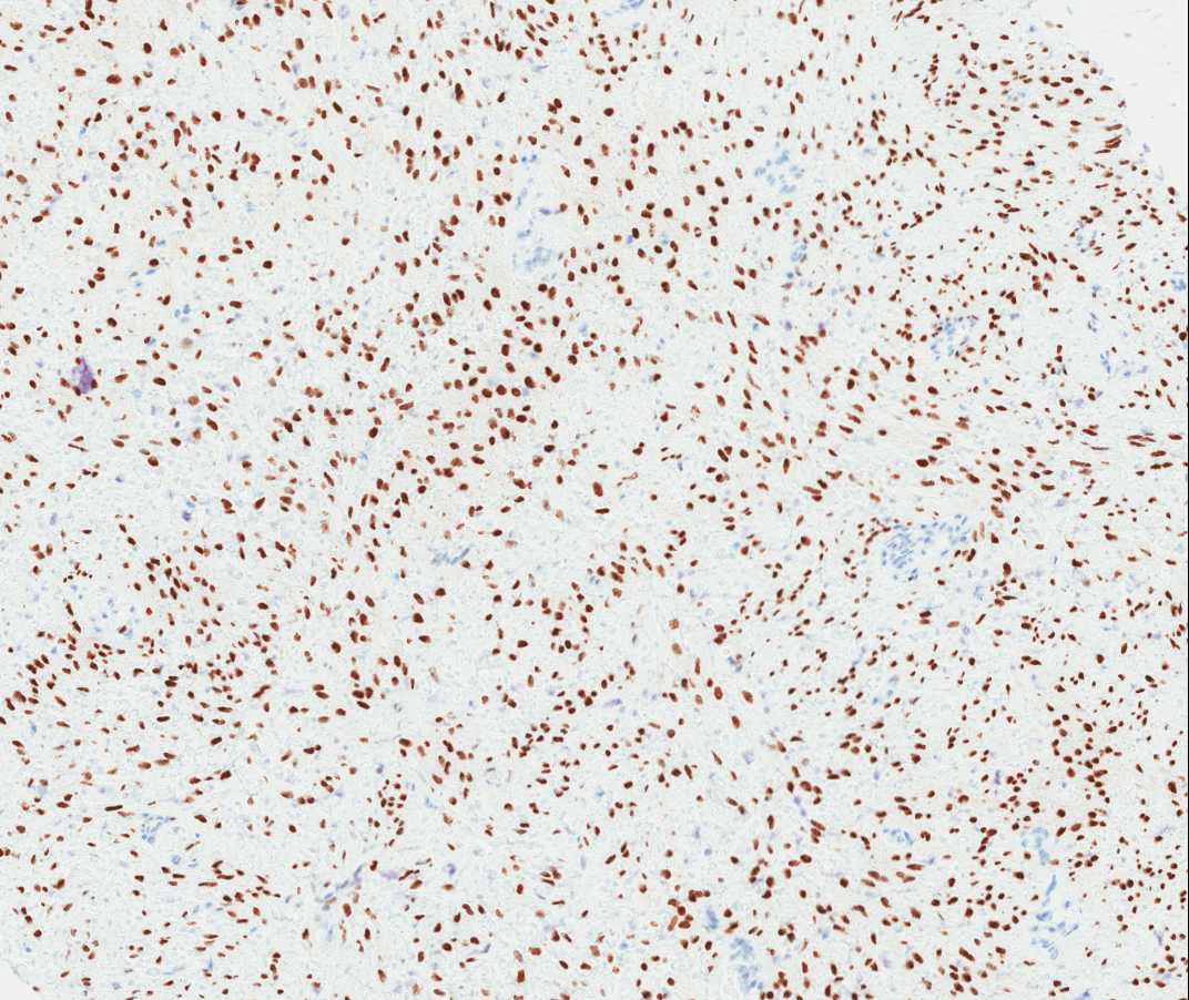 Case of the Month, Aug. 2012: Immunohistochemistry images - Figure 8