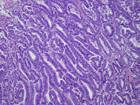 Case of the Month, Sept. 2012: Microscopic images - Figure 1