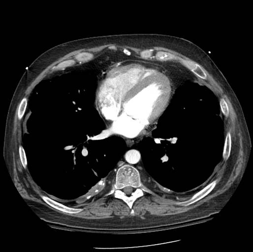 CT of Chest