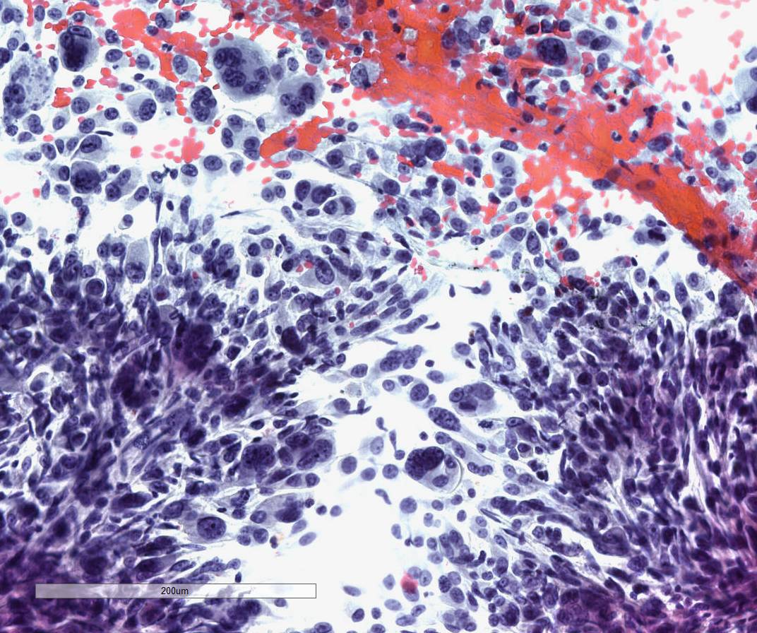 pancreatic mass showing giant cell and spindle cell morphology, 20X
