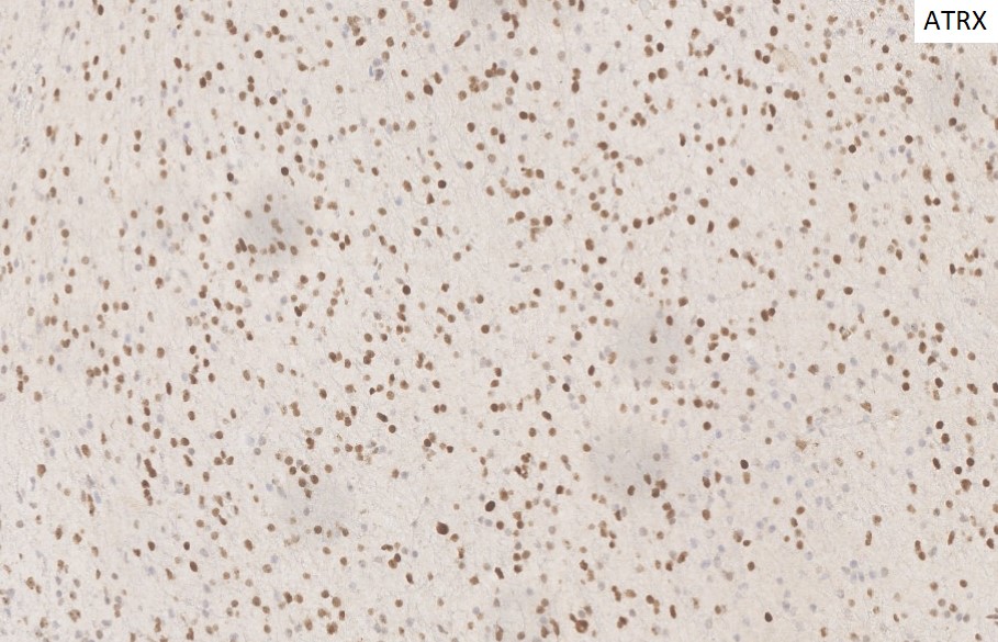 Figure 6: Immunohistochemical stains at 10x