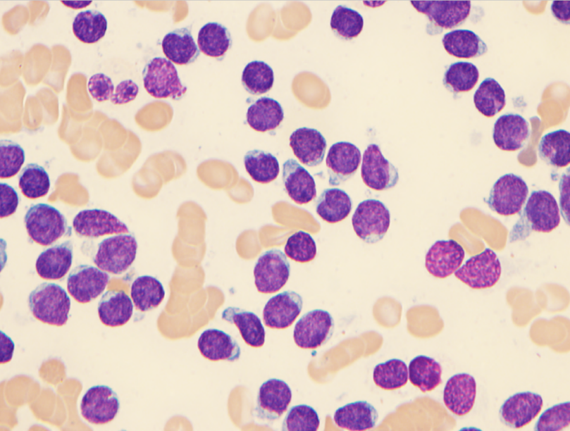 A bone marrow aspirate smear revealed diffuse involvement by a population of atypical medium-sized immature-appearing cells