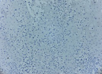 Anal perineum IHC GCDFP-15