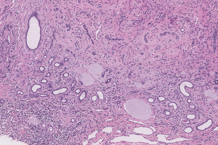 Figure 2. Immature tubules with surrounding collarette of spindle cell stroma (10x, 4x).