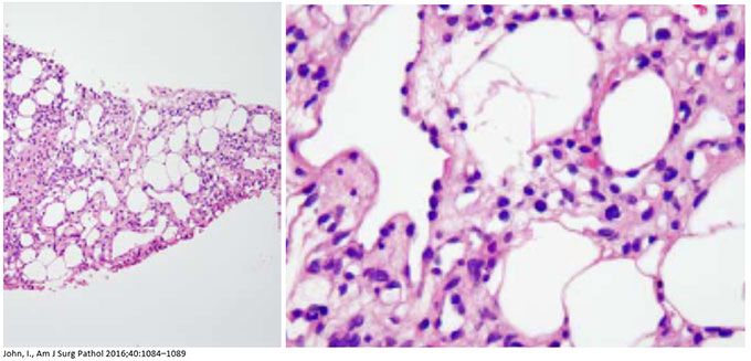 atelectasis histology