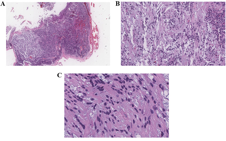 Figure 1 Intradural L1 tumor. H&E. A, 20x. B, 100x. C, 200x