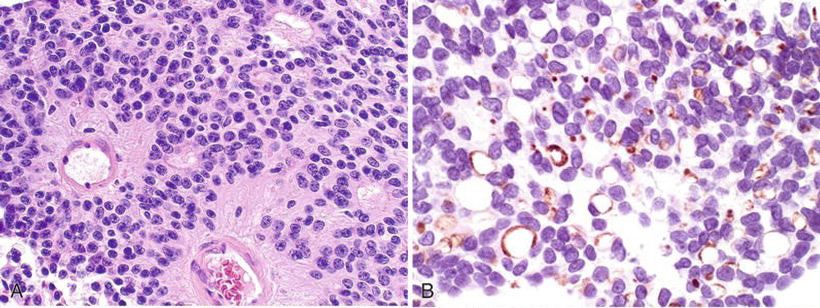 Figure 3 Ependymoma, classic type, WHO Grade II. A, H&E. B, EMA with   EMA-positive dot-like structures (From Ref. 2)