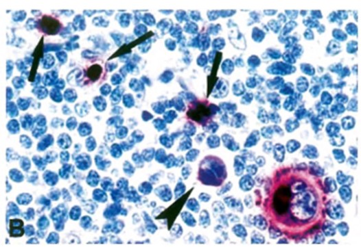 CD15: Membrane and perinuclear staining