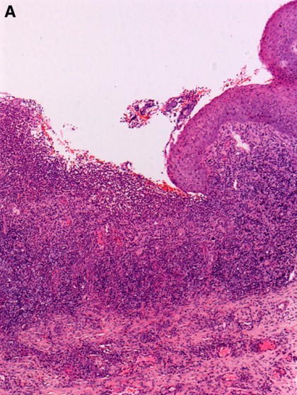 Biopsy of the 20-mm left lingual sulcular mucosa ulcer