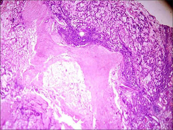 picture of tumor