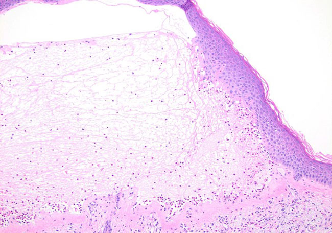 Close up of the subepidermal bulla with prominent eosinophils