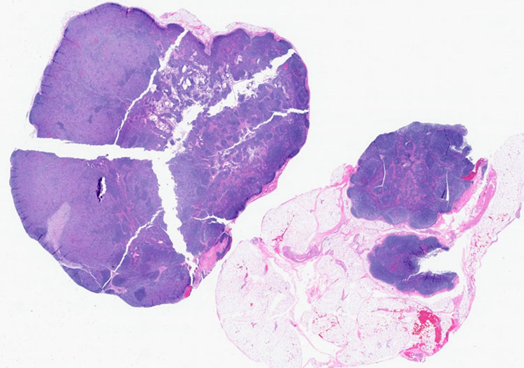 An axillary lymph node