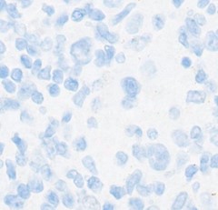 immunohistochemical stains supporting CHL diagnosis