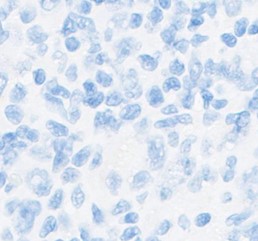 immunohistochemical stains supporting CHL diagnosis