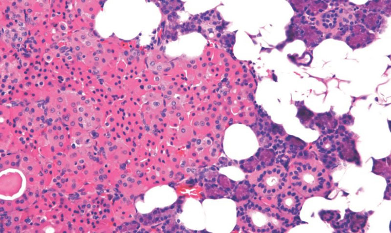 Oncocytosis with sheets of oncocytes
