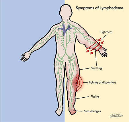 Symptoms of Lympedema on the body