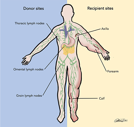 Vascularized Lymph Node Transplant (VLNT) 