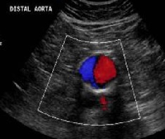 Abdominal Aortic Aneurism